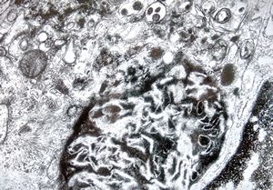 Whipple disease Whipple disease